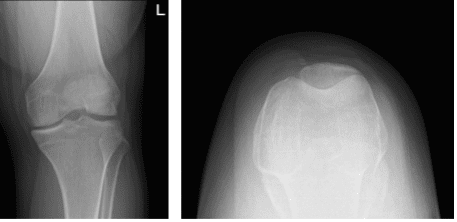 Radiografía de rodilla izquierda con rótula