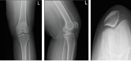 Radiografía de la rodilla izquierda con rótula