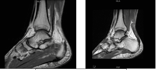 MRI-1.2T Tobillo izquierdo sin contraste