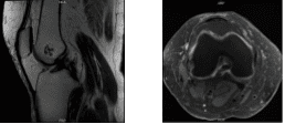 MRI-3T Rodilla derecha sin contraste