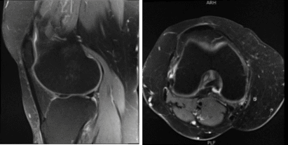 MRI-3T Rodilla sin contraste