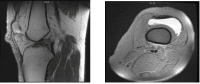 MRI-3T Rodilla izquierda sin contraste