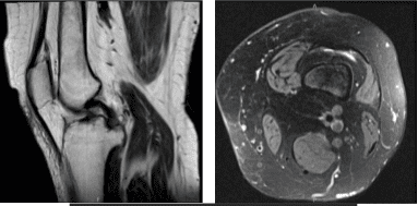 MRI-3T Rodilla izquierda sin contraste