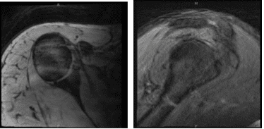 MRI-3T Hombro derecho sin contraste