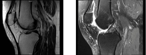 MRI-3T Rodilla derecha sin contraste