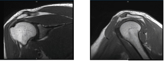 MRI-3T Hombro derecho sin contraste