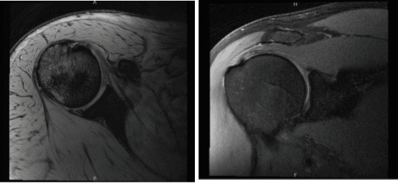 MRI-3T Hombro derecho sin contraste