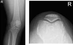 MRI-3T right knee non-contrast MRI-3T right knee non-contrast