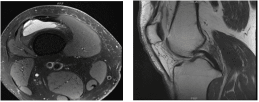 MRI-3T rodilla derecha sin contraste