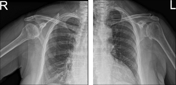 MRI of Left and Right Shoulder