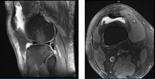 Resonancia magnética de rodilla