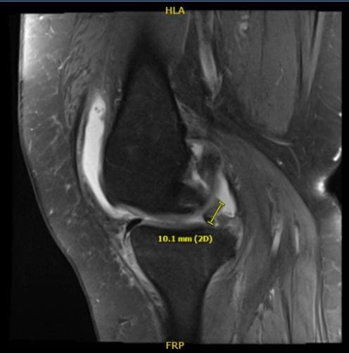 Resonancia magnética de la rodilla derecha