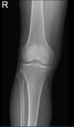 Resonancia magnética de la rodilla derecha