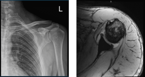 MRI of the biceps