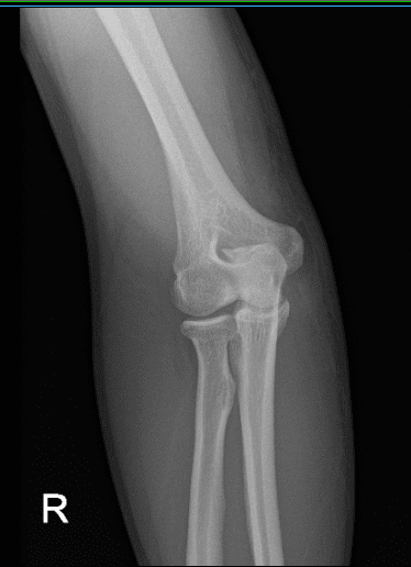 Radiografía postoperatoria del codo derecho