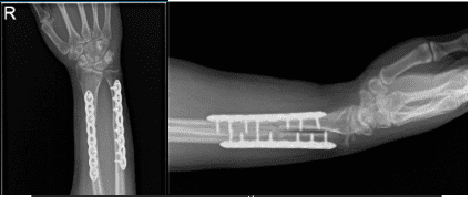 Radiografía del antebrazo derecho - 16ª semana postoperatoria