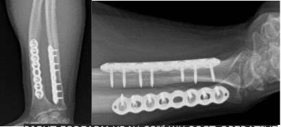 Radiografía del antebrazo derecho - 32ª semana postoperatoria