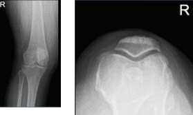 Right knee X-ray