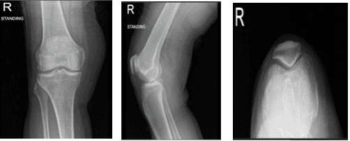 Radiografía de rodilla derecha con rótula