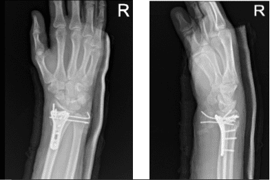 Radiografía de la muñeca derecha 3 o más vistas-primera semana postoperatoria