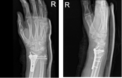 Radiografía de la muñeca derecha 3 o más vistas-2ª semana postoperatoria