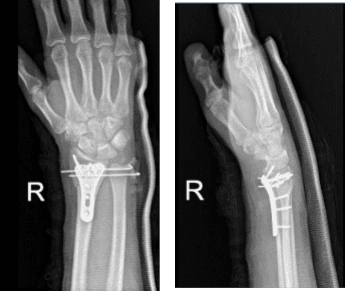 Radiografía de la muñeca derecha 3 o más vistas-4ª semana postoperatoria