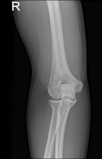 Radiografía del codo derecho