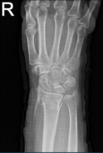 Right wrist X-ray 3 or more views