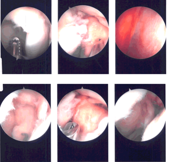 Imágenes de artroscopia intraoperatoria