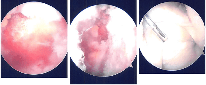 Imágenes artroscópicas intraoperatorias