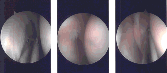 Imágenes de artroscopia intraoperatoria