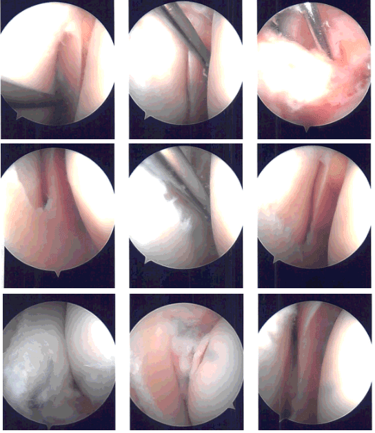 Imágenes de artroscopia intraoperatoria