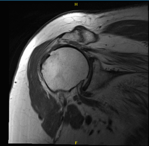 MRI-3T hombro derecho sin contraste